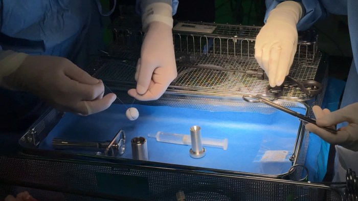 New technology cures gerd without surgery